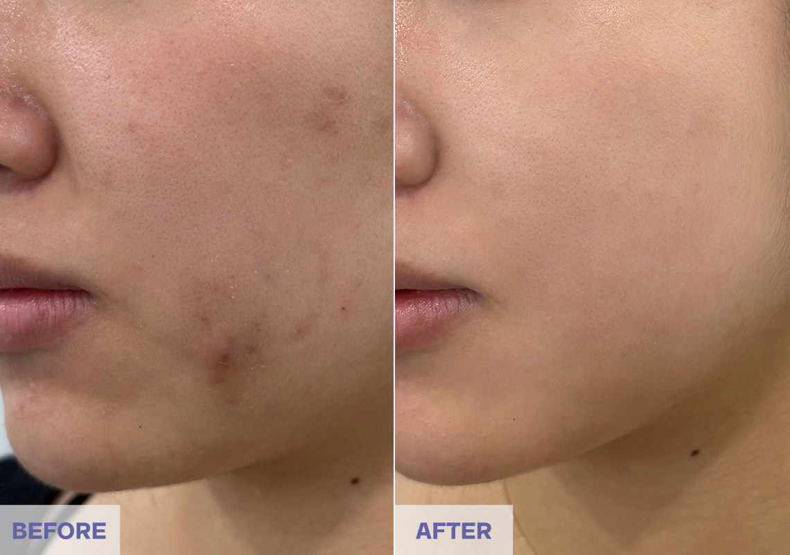 Before After 4 weeks