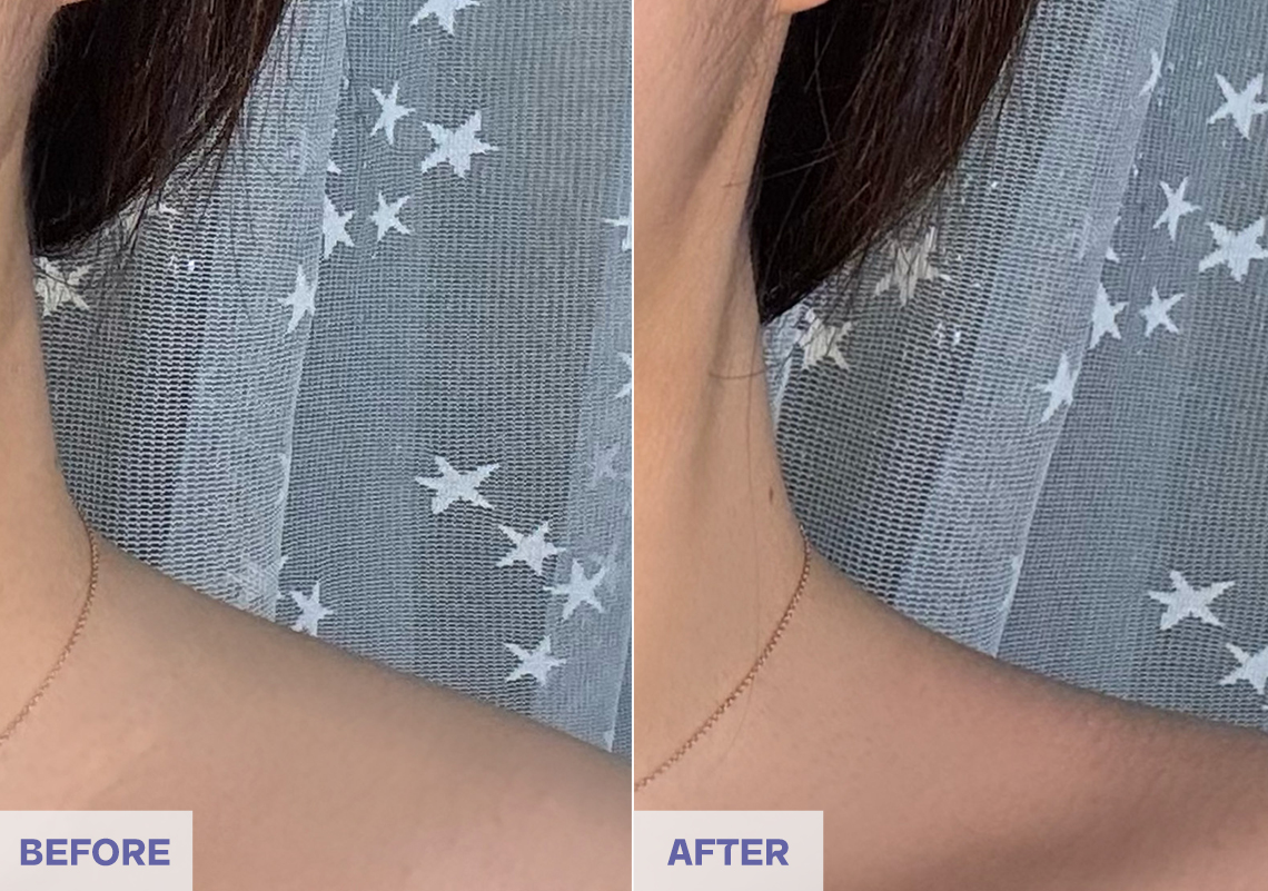 Before After 4 weeks