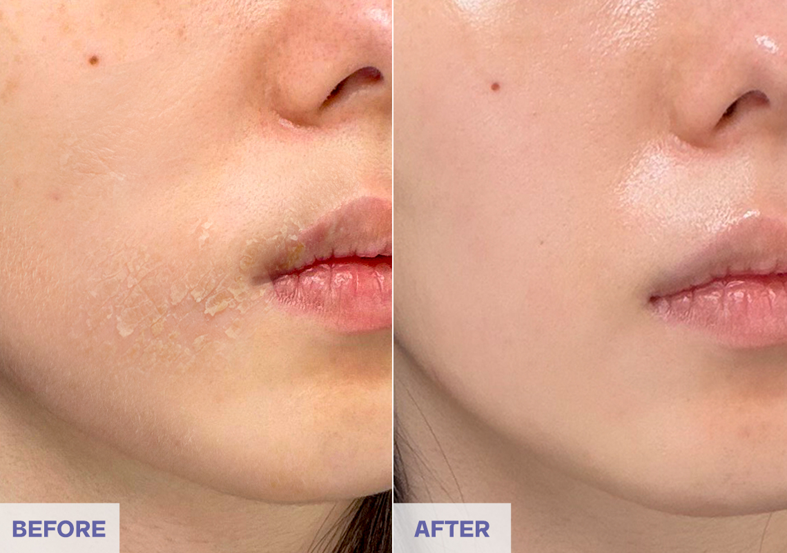 Before After 4 weeks