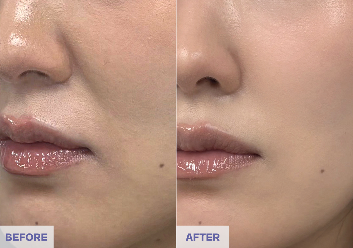 Before After 6 weeks