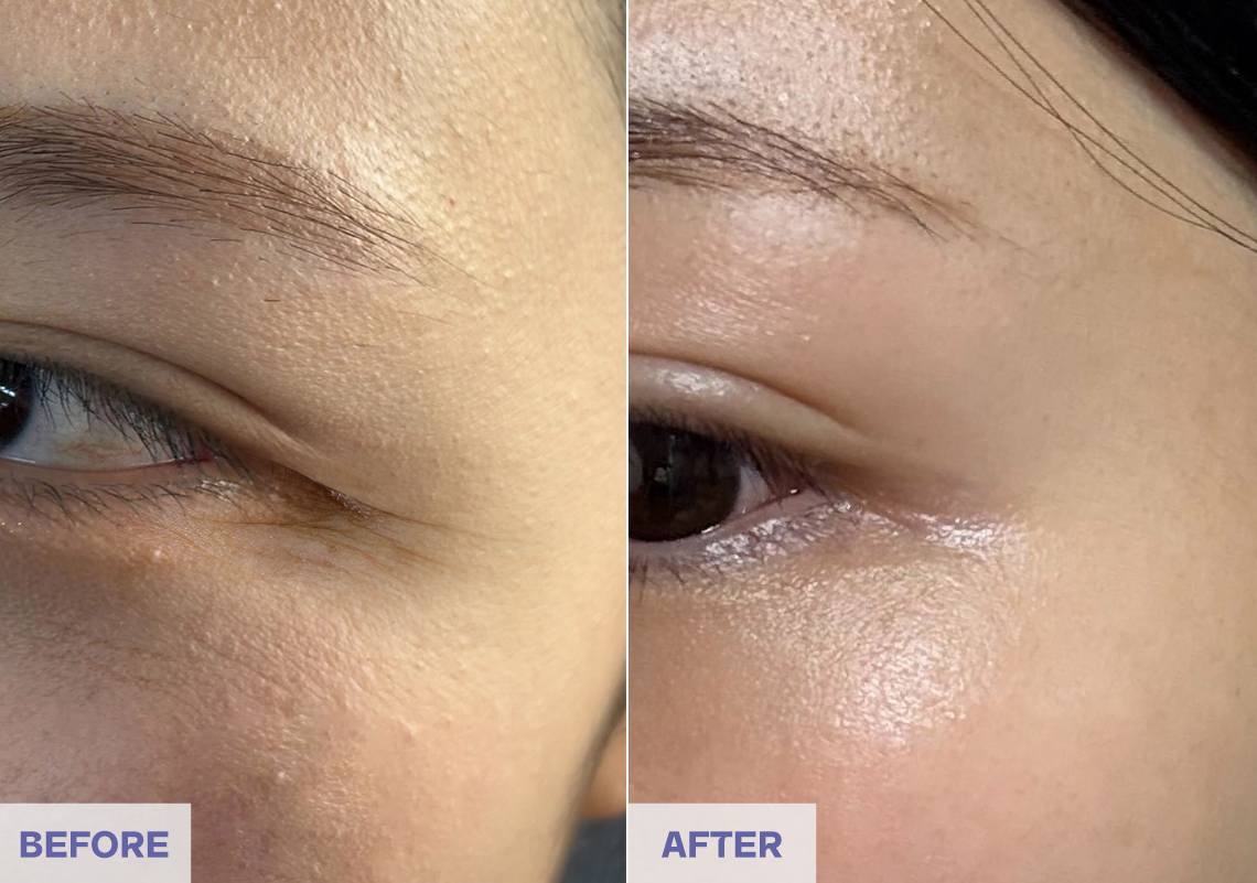 Before After 8 weeks