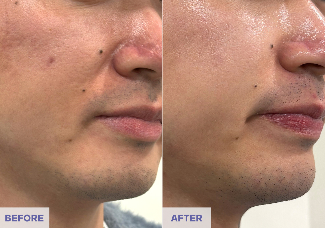 Before After 5 weeks