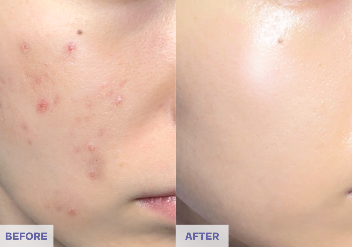 Before After 4 weeks