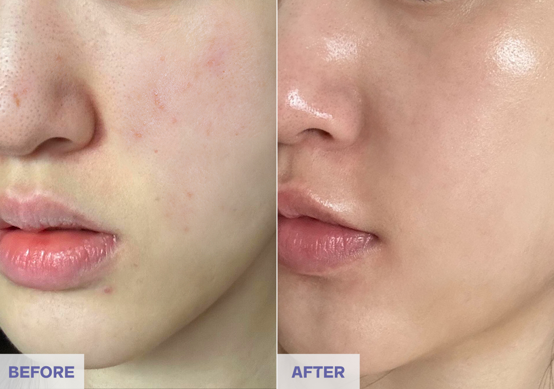 Before After 5 weeks