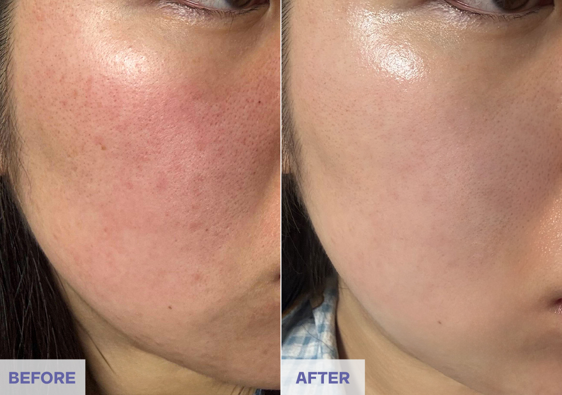 Before After 4 weeks