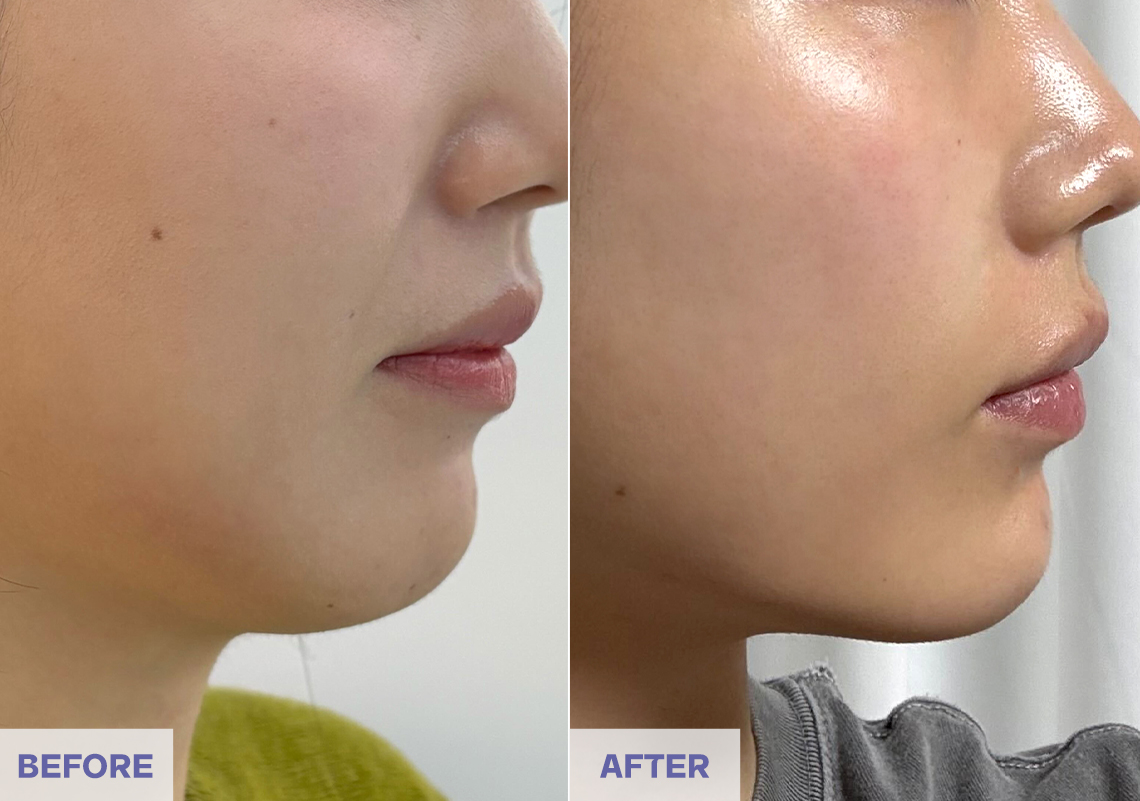 Before After 3 weeks